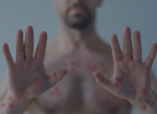 Lo que tienes que saber de la Viruela Símica Viruela del mono