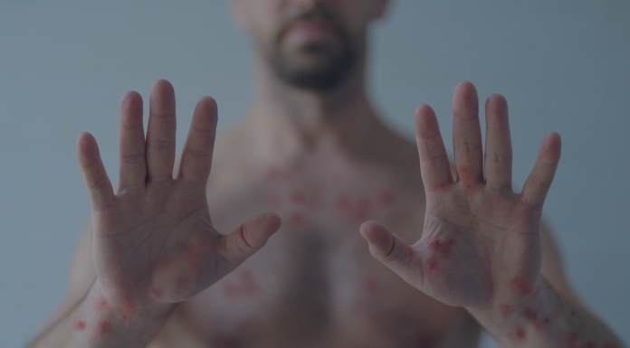 Lo que tienes que saber de la Viruela Símica Viruela del mono