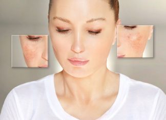 ¿Qué es la rosácea? Rosácea