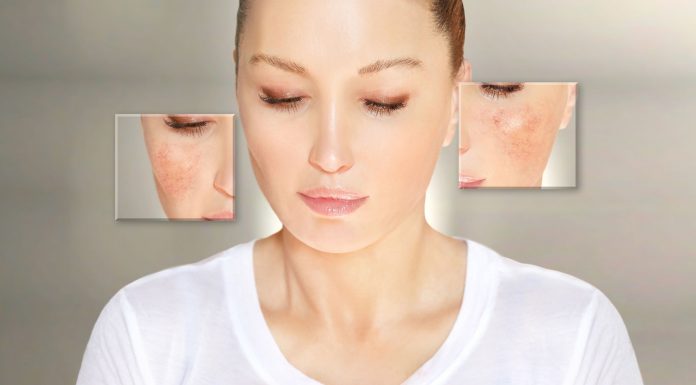 ¿Qué es la rosácea? Rosácea